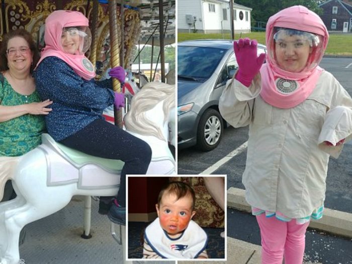 طفلة ترتدى ملابس رواد الفضاء بسبب حساسية نادرة